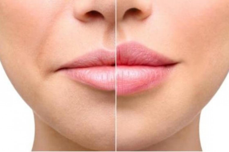 Аугментация губ: особенности и преимущества