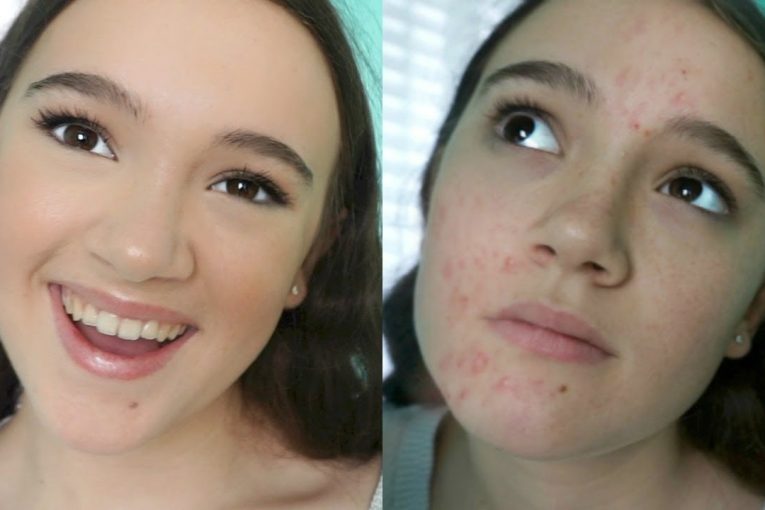 Covering Acne With Drugstore Makeup (Tutorial) FionaFrills