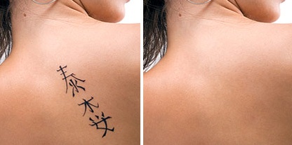 Выведение татуировок: что нужно знать