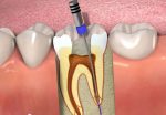 Лечение каналов зуба: в чем особенности?