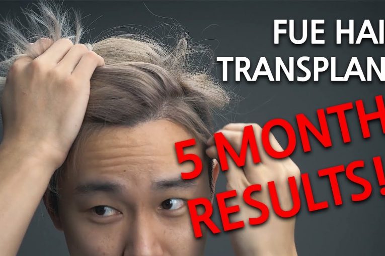 Hair Transplant in KOREA! [Part Two] [5 Month Results Update]