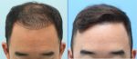 Пересадка волос: особенности и преимущества процедуры